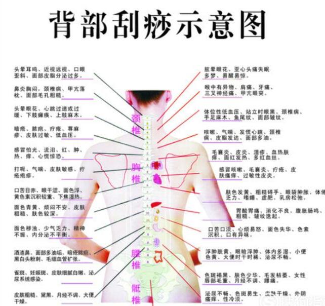 中医背部刮痧示意图