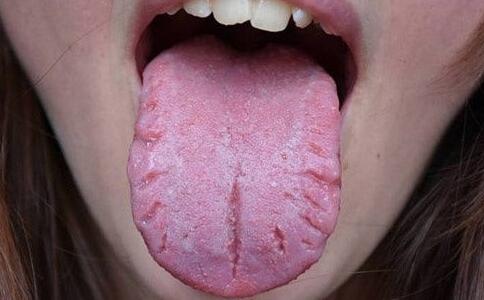 舌头边缘有齿痕怎么办